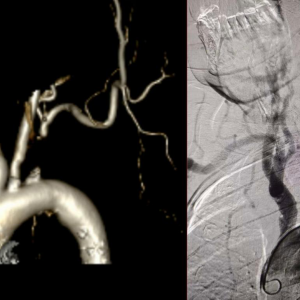 脉搏为何莫名消失？湘潭市第一人民医院介入微创术让老人脉动“失而复得” ...